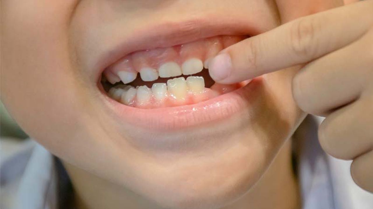 Çocuklarda kalıcı dişlerin sağlığını, iyi bakılan süt dişleri belirliyor