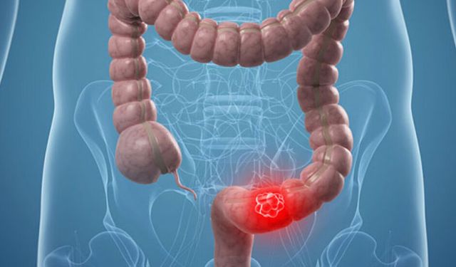 Kolon kanseri Güney Kıbrıs’ta en sık görülen üçüncü kanser türü